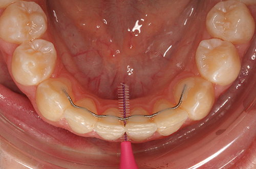 Bottom arch of teeth seen from above showing thin metal wire behind front four teeth